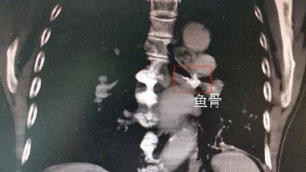 魚骨卡老翁氣管　家屬淡定：60年了