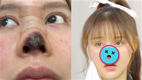 25歲女星整形「鼻頭發黑」！3個月後現況曝：肉長不回來▲。（圖／翻攝自鳳凰網娛樂微博）