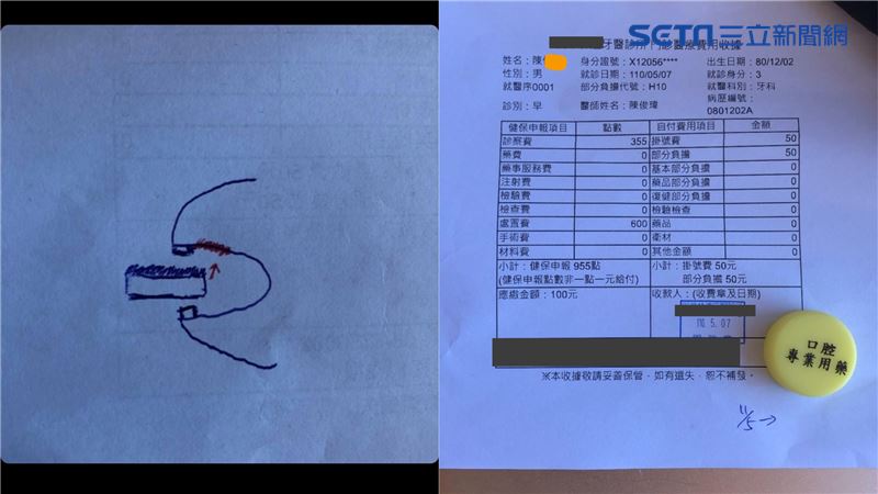 獨／大口咬「花生厚片」男上顎竟燙傷