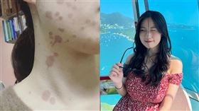 黃凱儀,香腸,油鍋,熱油,傷疤,燒傷(翻攝自 黃凱儀 IG)