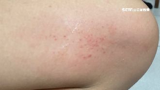 60名學生皮膚搔癢　疑甜桃絨毛過敏
