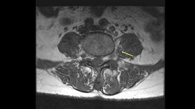 黃色箭頭為左側腰肌膿瘍處（圖／台北慈院提供）