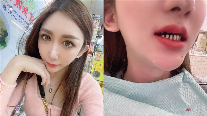 愛美一次磨牙16顆　她曬驚悚嘴內照