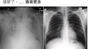肺炎,疫情,X光片,醫師,Shih Yu Ko,肺部（圖／翻攝醫師Shih Yu Ko臉書）