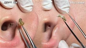 魔王級黑頭終現身！輕柔旋轉120s　耳窩拉出2龐然大物網全看傻