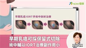 名家專用／NOW健康／早期乳癌IORT治療是在手術當下，直接對腫瘤病灶空腔進行高劑量照射，殲滅殘存癌細胞，只需1次療程，手術及放射治療同時完成。(勿用)