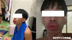 香腸嘴,梁朝偉,急診,過敏,蔥油餅(廖先生 授權提供)