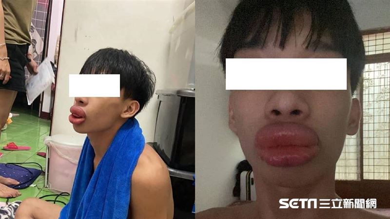 帥男腫成香腸嘴　網愣：花蓮梁朝偉？