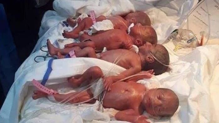 世界紀錄9胞胎滿月　4男5女都存活