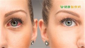 視線不清、畏光、眼部有異物感、酸澀，都是乾眼疾病的症狀，但由於病徵往往來的突然，多數人選擇短暫休息、或是購買眼藥水救急舒緩，反而在不知不覺中，造成症狀更加惡化。