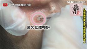 ▼▲該名客人毛孔裡有巨大黑頭粉刺。（圖／真 · 時尚無痛清粉刺 授權）