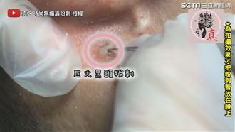 巨大黑頭粉刺藏超深　美容師勾拉夾出