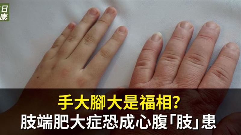 手大腳大當心「肢端肥大症」莫輕忽！