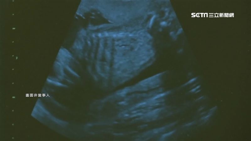 羊膜穿刺查出寶寶患病　她揭痛處助人
