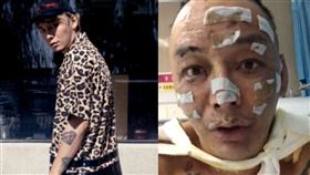 徐真真睡覺點薰香未熄滅，引發失火，全身40%二級燒傷。（圖／翻攝自徐真真微博） 