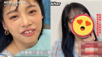 牙縫大到會漏水　她曝裝牙貼片反差