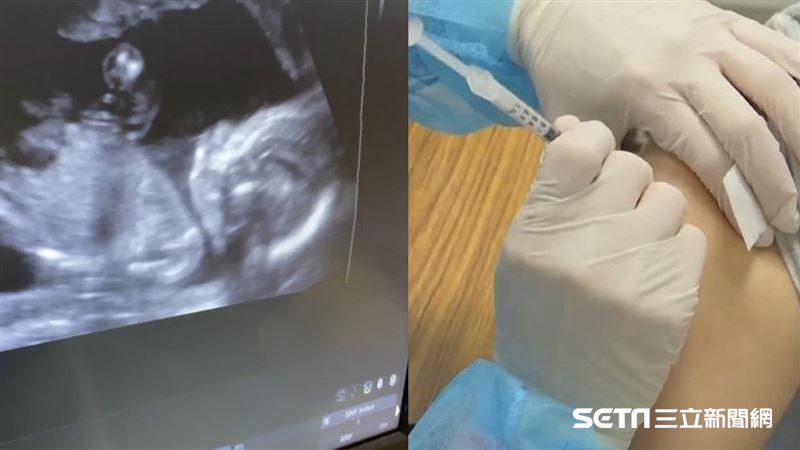 孕婦打疫苗安全嗎？醫師解答曝關鍵