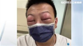 誇張! 吃中藥引發過敏 雙眼紅腫