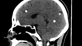 福建,癲癇,女兒,腦囊蟲,生魚片,寄生蟲《福建衛生報》