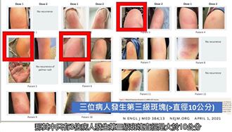 打莫德納疫苗竟產生「新冠手臂」