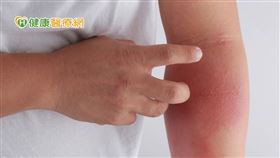 台灣疫情升溫，許多患者疫情期間不敢就醫治療。對此，黃毓惠醫師強調，異位性皮膚炎需要長期的穩定治療，由於疾病不會斷根，若任意停藥，就會再復發及惡化。