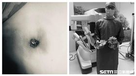 一名30多歲的女子，短時間腹部膨脹就醫，核磁共振後發現了一顆20公分的子宮肌瘤。（圖／婦產科醫師李偉浩授權提供）