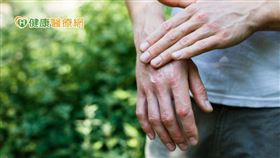 乾癬是一種全身發炎的自體免疫疾病，不只皮膚發炎，更會引發身體多種併發症，比如關節炎、眼睛葡萄膜炎，更可能合併新陳代謝症候群，包含高血糖、高血壓、高血脂等三高疾病，增加冠狀動脈心臟病、腦中風等心血管共病的死亡率。