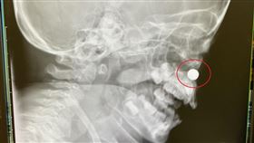 2歲童想吐、鼻子流黃膿　就醫才知電池卡鼻腔內（圖／長安醫院提供）
