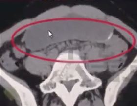 撐破肚皮,喝酒,拚酒,危險,胃擴張