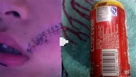 男童冰箱拿出「冷凍可樂」！開罐後爆炸　臉頰噴血縫38針