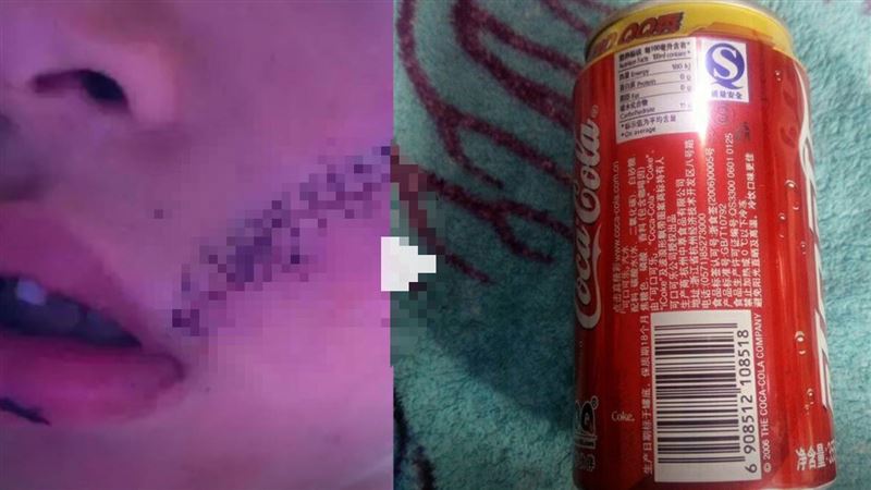 男童冰箱拿出冷凍可樂　爆炸縫38針