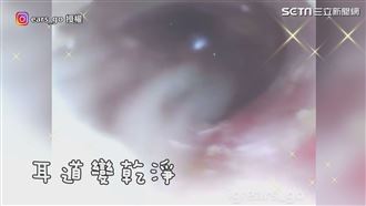 採耳師輕柔勾夾　巨大耳結石全掏出