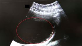 超音波掃描發現王女士骨盆內有一顆將近20公分的腫瘤(紅圈處)，經單孔腹腔鏡微創手術後，順利恢復健康（圖／大千綜合醫院提供）
