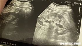 腎結石(讀者提供)
