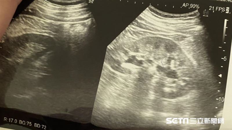 腎結石會遺傳。(圖/資料照)