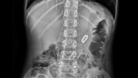 12歲男童，誤吞磁力球，圖／中國附醫提供