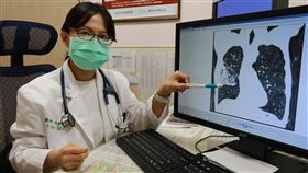 陳鈴宜醫師說明，，慢性阻塞性肺病的形成是因外來刺激性物質（例如抽煙、空汙或環境有害物質吸入），導致氣道反覆發炎，產生結構上變化（圖／亞大醫院提供）