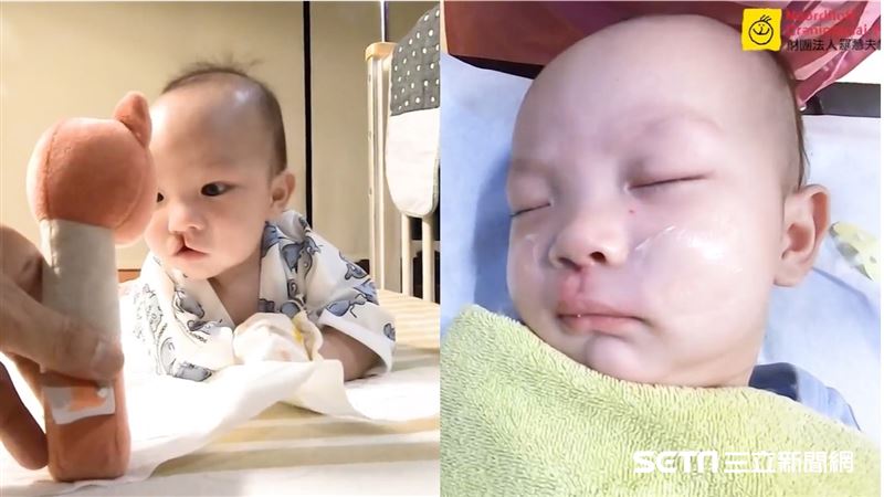 唇顎裂男嬰首次手術　1小時後更帥了