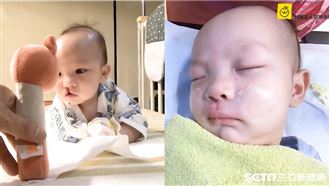唇顎裂男嬰首次手術　1小時後更帥了