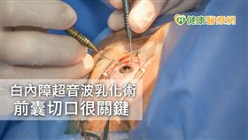 一般白內障手術是透過醫師以器械手動撕開前囊，王凱筠醫師表示，前囊袋非常薄，又要保持完整性，考驗醫師技術，更需要患者高度配合，「萬一患者無法控制眼球亂動，很容易影響手術進行。」