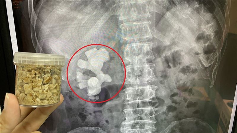 男腰痛血尿　8公分鹿角大結石塞腎臟