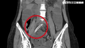▲吃爌肉太過癮　女竟吞下整根牙籤！腹痛發燒腸穿孔差點沒命 消化外科 徐瑋呈醫師（圖／衛福部臺中醫院提供）