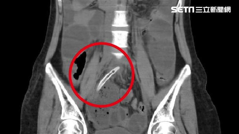 爽吃爌肉　女竟吞「整根牙籤」腸穿孔