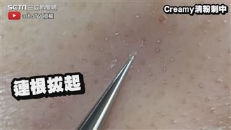 男粉刺全冒出　美容師根根拔起秒光滑