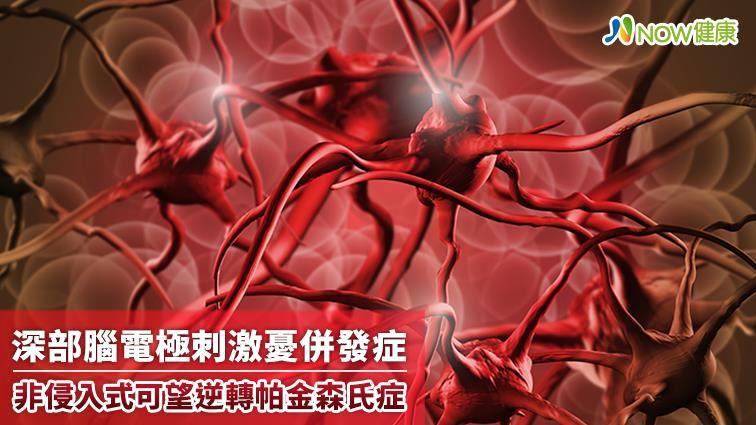 非侵入式可望逆轉帕金森氏症