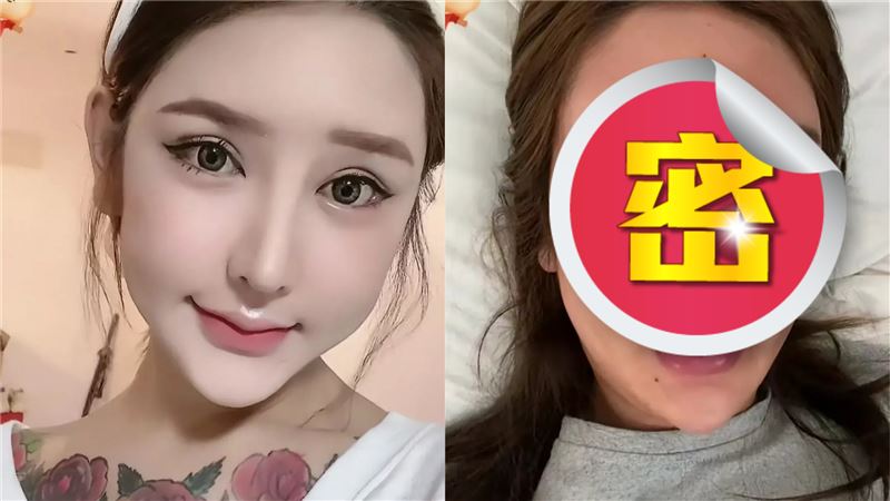網紅打400多支玻尿酸　臉變形崩潰