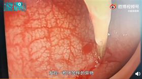 廣東男將牙籤吞入（圖／翻攝自漩渦視頻）