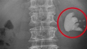 鹿角結石（台中醫院提供）