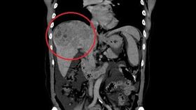 67歲翁肝癌「肺轉移還侵犯心臟」　免疫療法讓他重生（安南醫院提供）