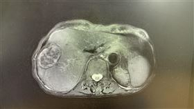 ▲8旬婦人檢查發現6公分大的肝癌腫瘤。（圖／黃釧峰醫師提供）